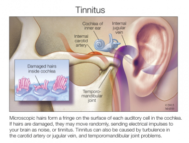 La ansiedad y el Tinnitus