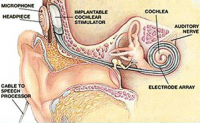 Upyd inquiere al gobierno por el "monopolio" de los audífonos de los implantes cocleares